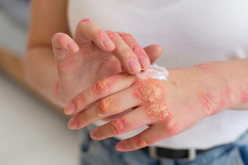 psoriasis treatment in Karama