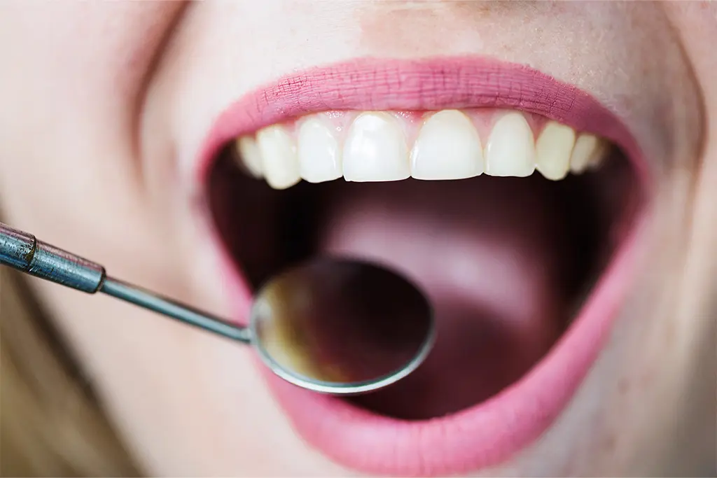 The Complete Guide to Teeth Stains: What Causes Them and How to Avoid Them