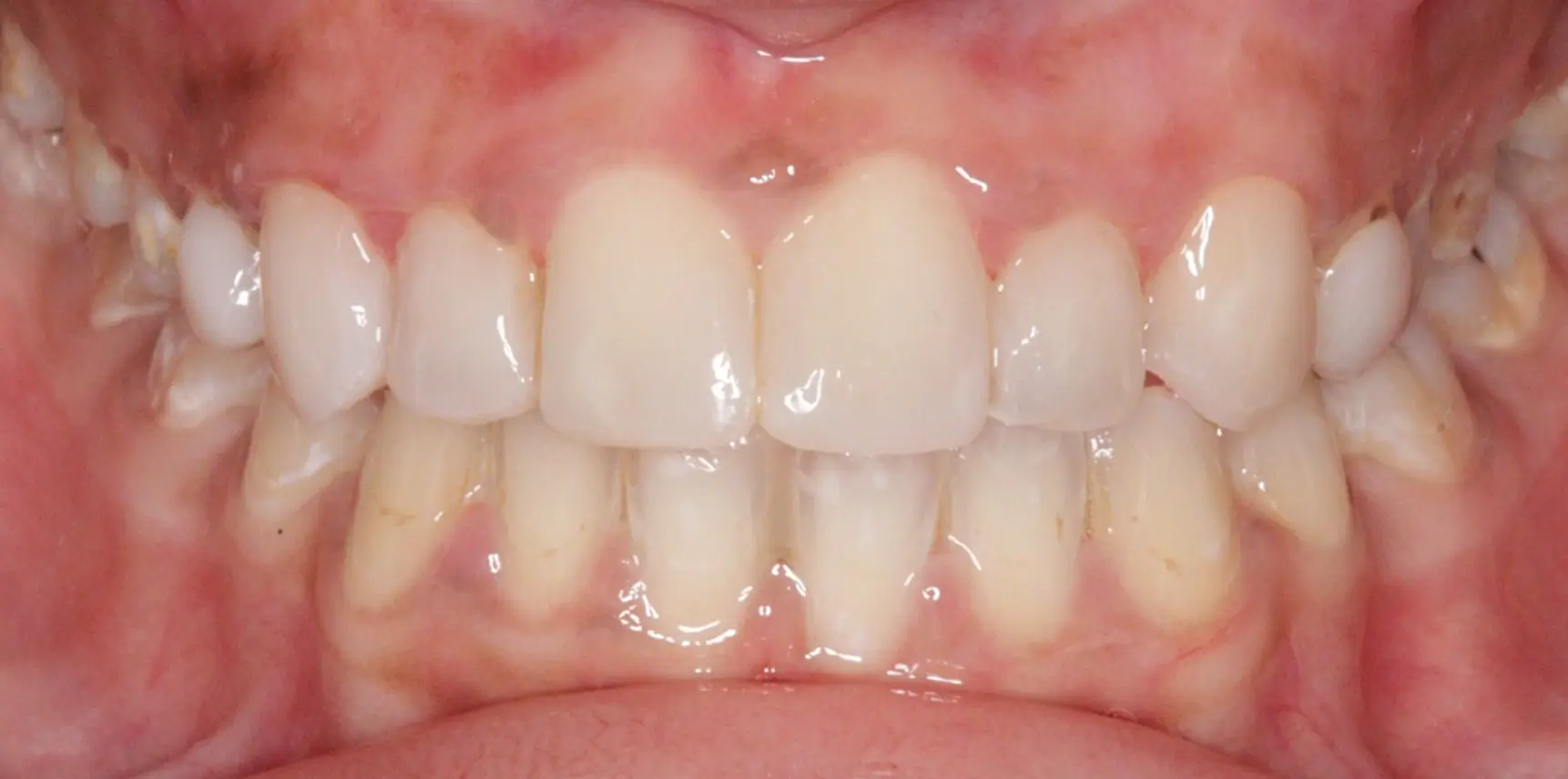 6-a Composite veneer