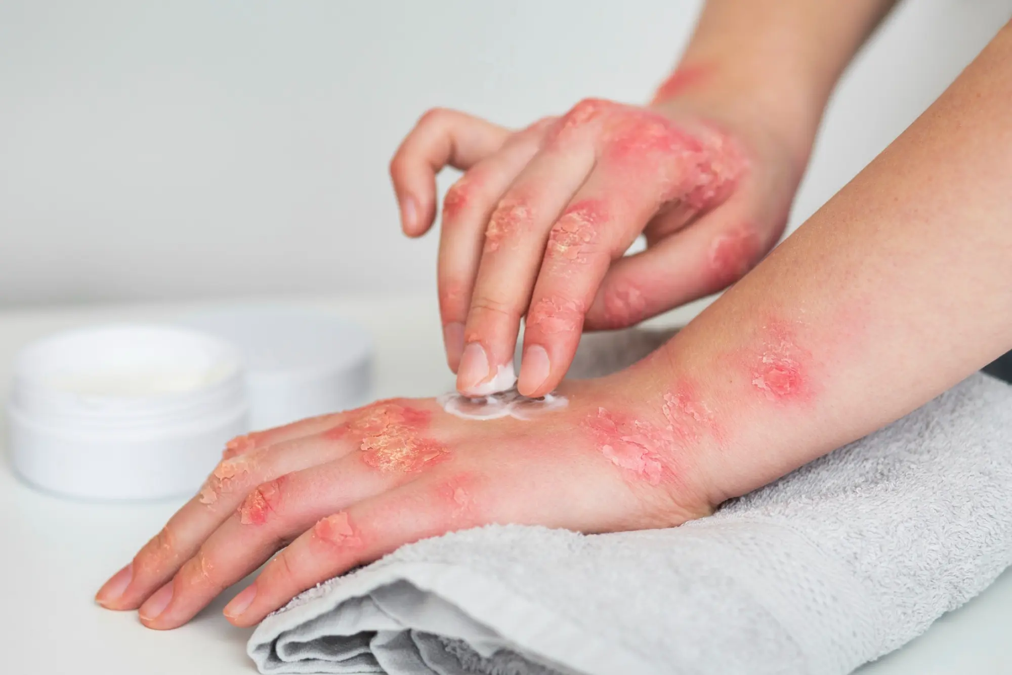 Psoriasis Treatment
