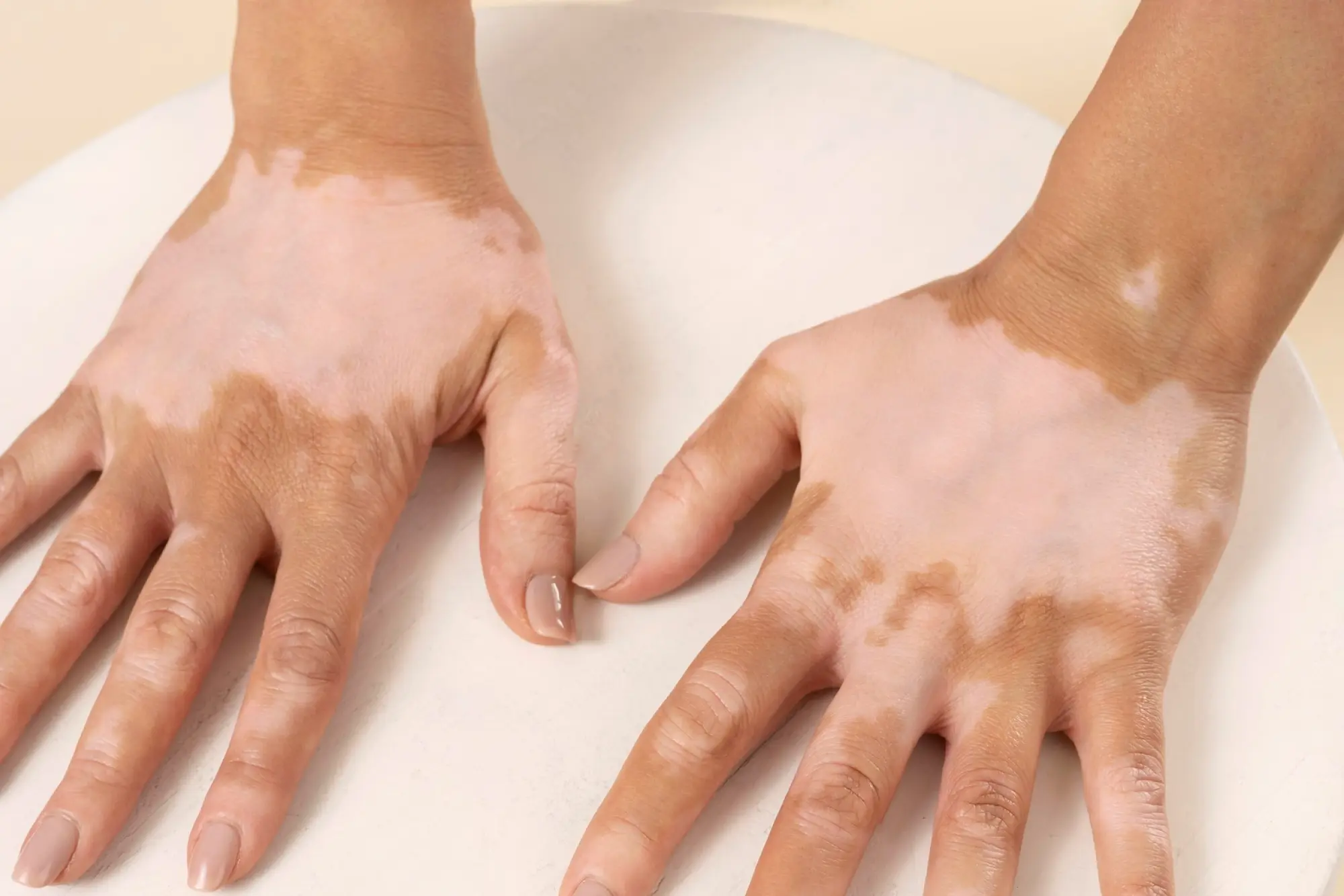 Vitiligo Management