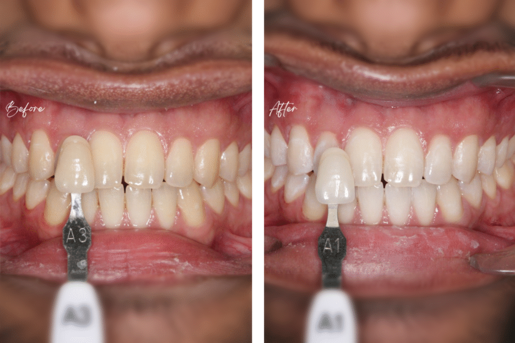 Want a Brighter Smile?