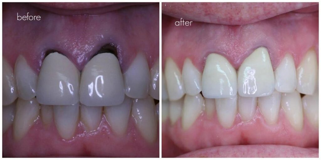 Dental Crown Replacement