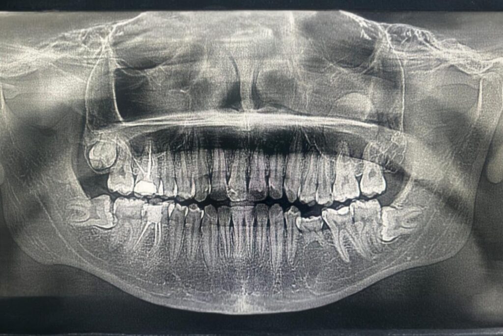 Wisdom Tooth Removal