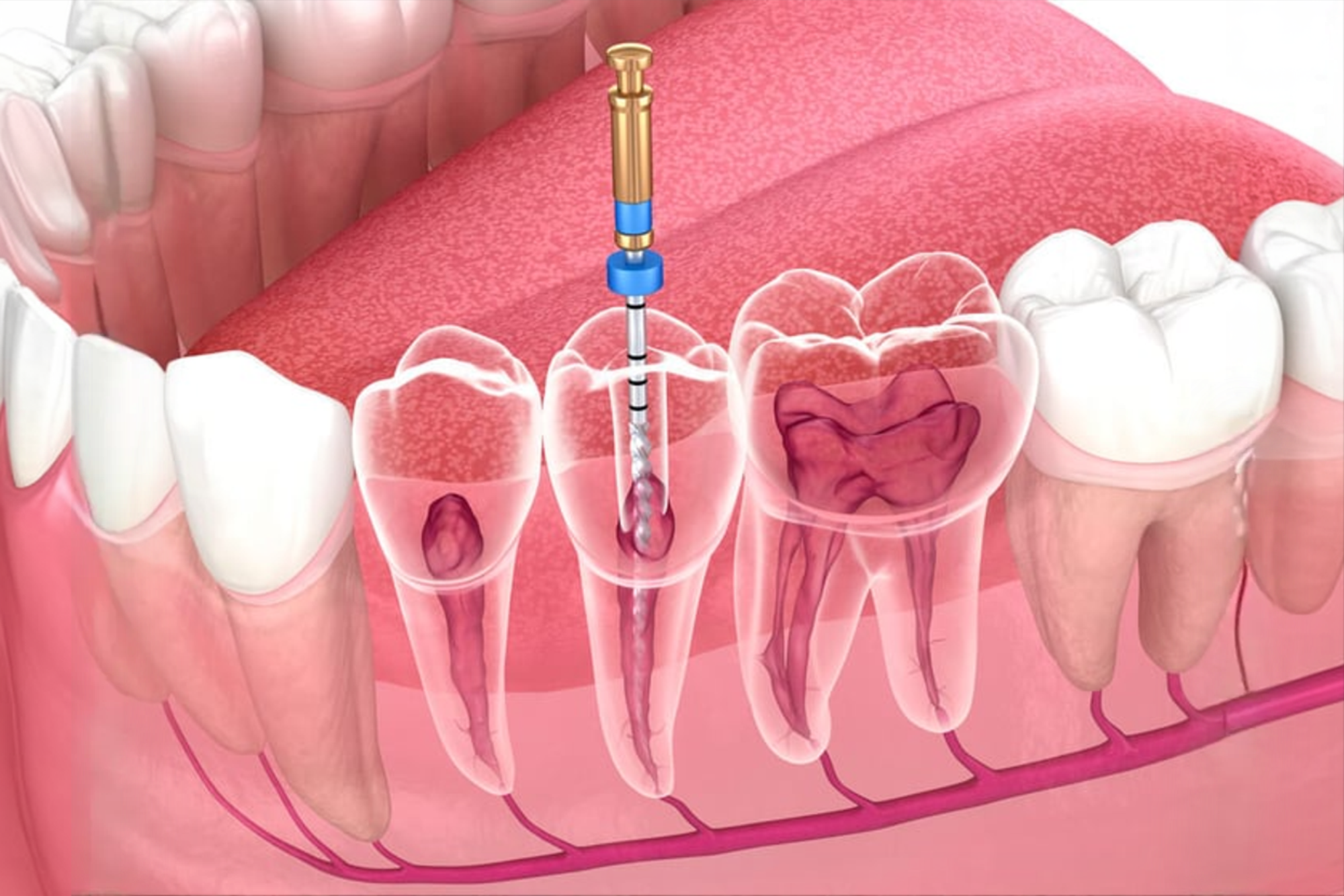 Retreatment in Endodontics