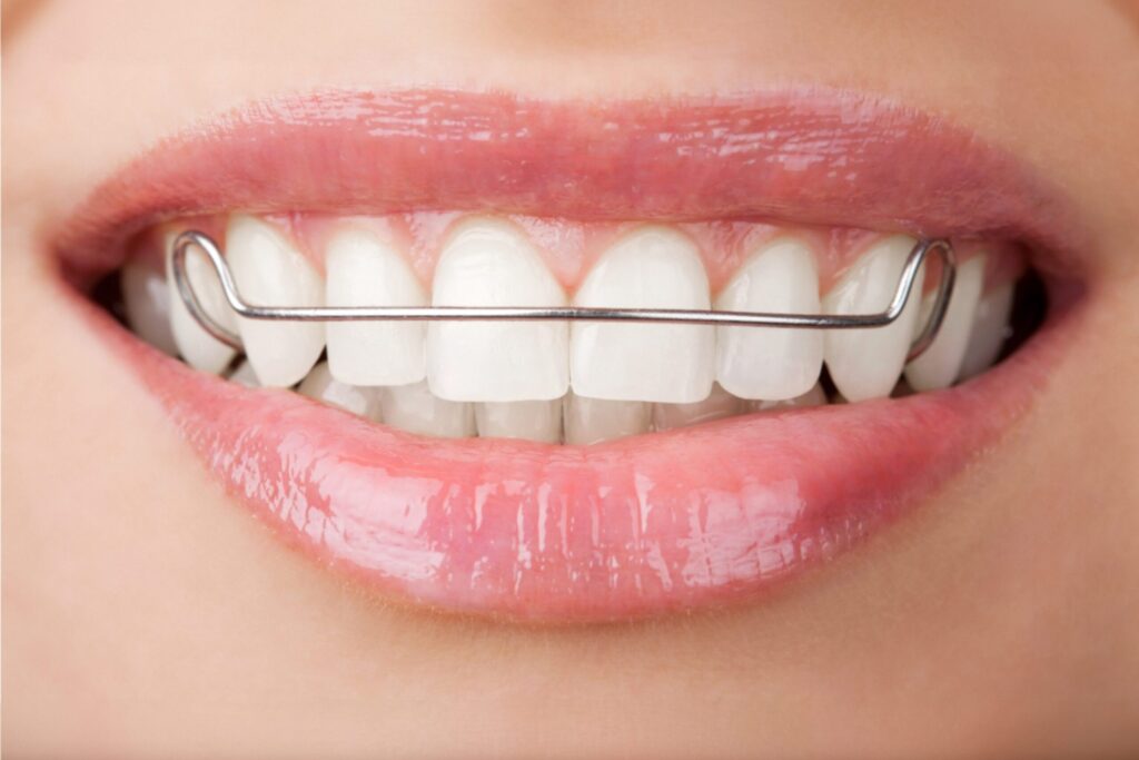 Orthodontic Treatment