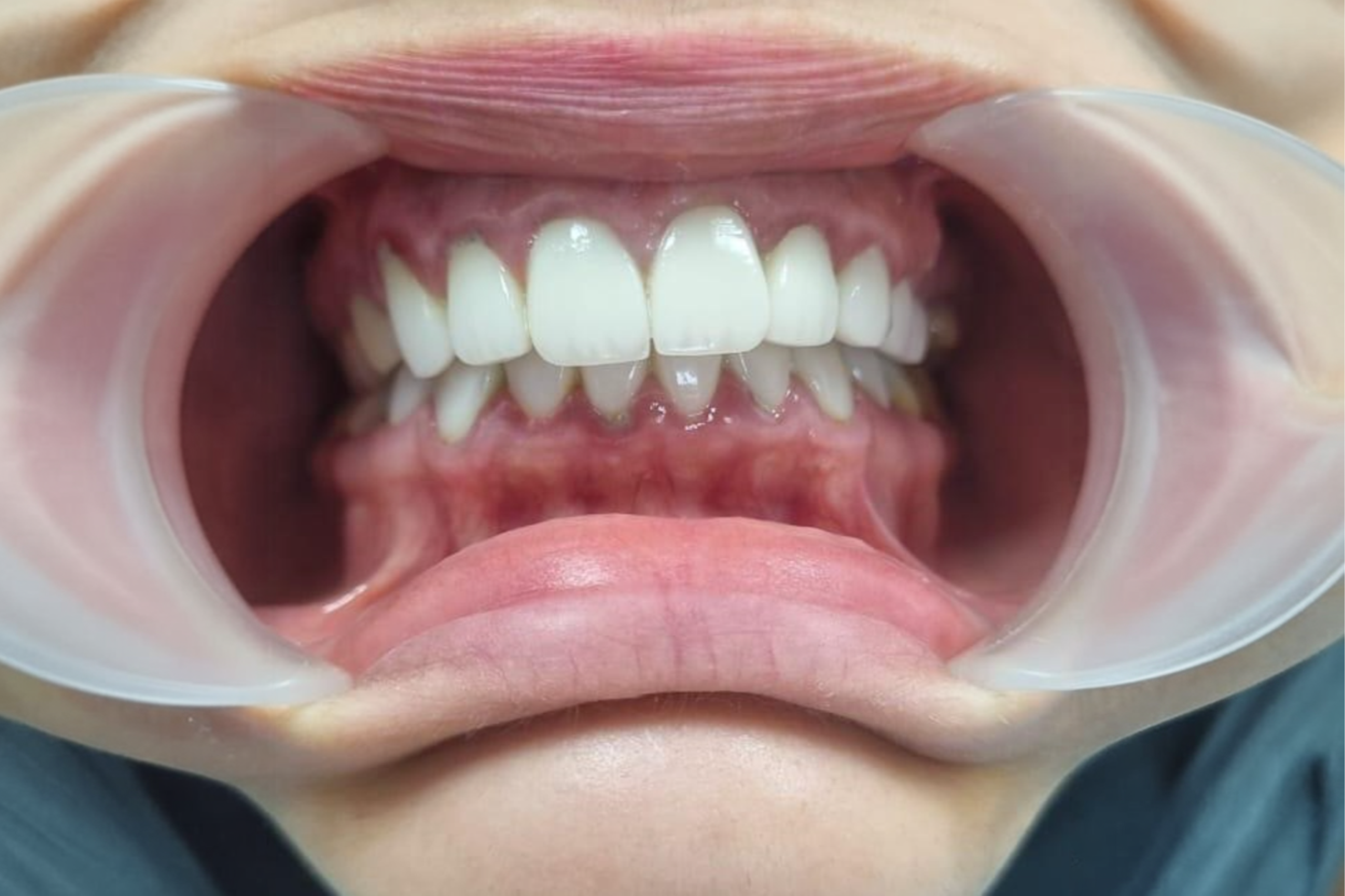 gum disease treatment