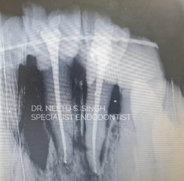 after placement into the socket and splinting