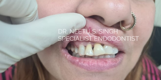 Follow up of the after six months