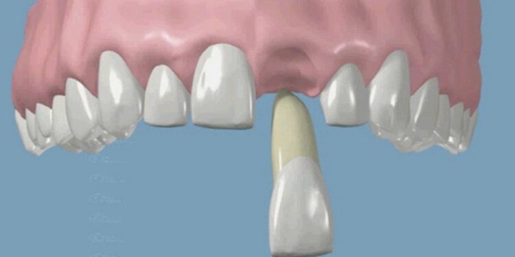 Reimplantation of an Avulsed Tooth – Save it. Don’t lose it. Reimplant it.