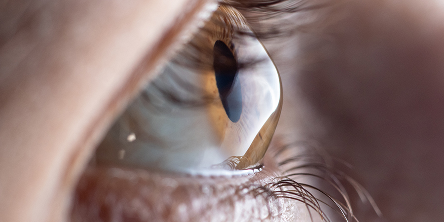 Keratoconus Treatment in Dubai: Causes, Symptoms & Treatment